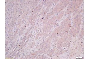 Formalin-fixed and paraffin embedded human laryngocarcinoma tissue labeled with Anti-COMMD4 Polyclonal Antibody, Unconjugated 1:400 followed by conjugation to the secondary antibody and DAB staining.