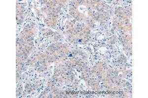 Immunohistochemistry of Human liver cancer using PARD6A Polyclonal Antibody at dilution of 1:60 (PARD6A 抗体)