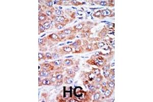 Formalin-fixed and paraffin-embedded human cancer tissue reacted with the primary antibody, which was peroxidase-conjugated to the secondary antibody, followed by DAB staining. (NME4 抗体  (N-Term))