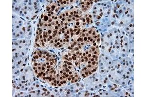 Immunohistochemical staining of paraffin-embedded Adenocarcinoma of colon tissue using anti-KIAA1609 mouse monoclonal antibody. (KIAA1609 抗体)