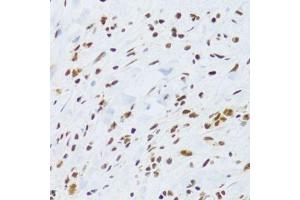 Immunohistochemistry of paraffin-embedded human gastric cancer using DDB1 Antibody. (DDB1 抗体)