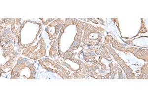 Immunohistochemistry of paraffin-embedded Human thyroid cancer tissue using C9orf116 Polyclonal Antibody at dilution of 1:55(x200) (C9ORF116 抗体)