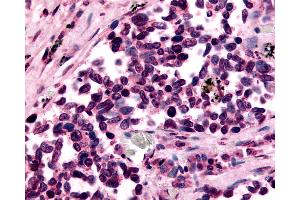 Anti-GPR182 / ADMR antibody IHC of human Lung, Small Cell Carcinoma. (G Protein-Coupled Receptor 182 抗体  (N-Term))