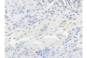 ABIN6254899 and ABIN6267063 at 1/100 staining human tongue carcinoma by IHC-P.