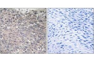 Immunohistochemistry analysis of paraffin-embedded human cervix carcinoma, using Inositol 1, 4, 5-trisphosphate R1 (Phospho-Ser1598/1588) Antibody. (ITPR1 抗体  (pSer1598))