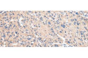 Immunohistochemistry of paraffin-embedded Human liver cancer using VAMP4 Polyclonal Antibody at dilution of 1/30 (VAMP4 抗体)