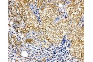 Anti-Vinculin antibody, IHC(P) IHC(P): Human Mammary Cancer Tissue (Vinculin 抗体  (N-Term))