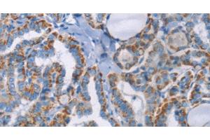 Immunohistochemistry of paraffin-embedded Human thyroid cancer using GPA33 Polyclonal Antibody at dilution of 1:30 (GPA33 抗体)