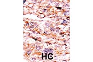 Formalin-fixed and paraffin-embedded human hepatocellular carcinoma tissue reacted with ACVR2A polyclonal antibody  , which was peroxidase-conjugated to the secondary antibody, followed by AEC staining. (ACVR2A 抗体  (N-Term))