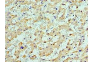 Immunohistochemistry of paraffin-embedded human liver cancer using ABIN7149372 at dilution of 1:100 (ALDH1L1 抗体  (AA 1-250))