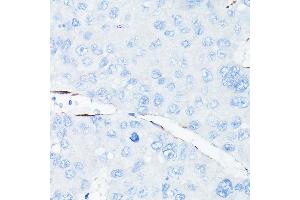Immunohistochemistry of paraffin-embedded human liver cancer using CDH5 Rabbit pAb (ABIN6134029, ABIN6138297, ABIN6138298 and ABIN6216033) at dilution of 1:150 (40x lens).