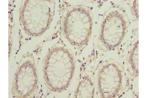 Immunohistochemistry of paraffin-embedded human colon cancer using ABIN7148308 at dilution of 1:100 (COMMD2 抗体  (AA 5-199))