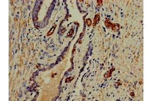 Immunohistochemistry of paraffin-embedded human prostate cancer using ABIN7156227 at dilution of 1:100 (PFAS 抗体  (AA 1064-1302))
