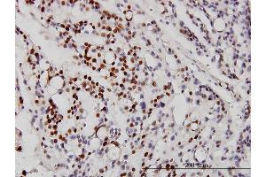 Immunoperoxidase of monoclonal antibody to NEUROD1 on formalin-fixed paraffin-embedded human ovary, clear cell carcinoma.