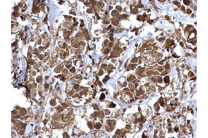 IHC-P Image NFkB p65 antibody detects NFkB p65 protein at cytosol and nucleus on human breast carcinoma by immunohistochemical analysis. (NF-kB p65 抗体  (Center))