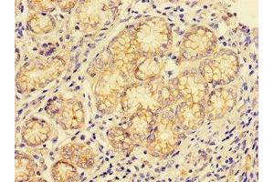 Immunohistochemistry of paraffin-embedded human gastric cancer using ABIN7147004 at dilution of 1:100 (Cathepsin E 抗体  (AA 59-155))