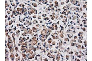Immunohistochemical staining of paraffin-embedded Adenocarcinoma of Human colon tissue using anti-AQP1 mouse monoclonal antibody. (Aquaporin 1 抗体)