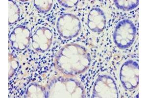 Immunohistochemistry of paraffin-embedded human colon cancer using ABIN7144924 at dilution of 1:100 (ABCE1 抗体  (AA 320-599))