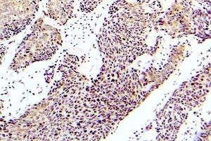 Immunohistochemistry (IHC) analyzes of p-ASK1 antibody in paraffin-embedded human lung adenocarcinoma tissue. (ASK1 抗体  (pSer83))