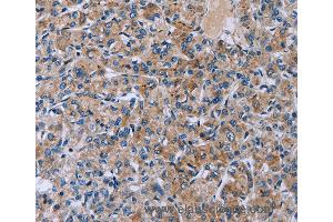 Immunohistochemistry of Human prostate cancer using HSD3B2 Polyclonal Antibody at dilution of 1:50 (HSD3B2 抗体)