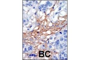 Formalin-fixed and paraffin-embedded human cancer tissue reacted with the primary antibody, which was peroxidase-conjugated to the secondary antibody, followed by AEC staining. (PIP5K1C 抗体  (C-Term))