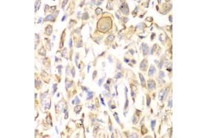 Immunohistochemistry of paraffin-embedded human lung cancer using CD151 antibody. (CD151 抗体)