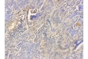 ABIN6256525 and ABIN6267600 at 1/100 staining human lung adenocarcinoma by IHC-P. (NF-kB p65 抗体  (pThr254))