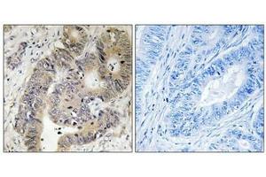 Immunohistochemical analysis of paraffin-embedded human colon carcinoma tissue using CAD (Phospho-Thr456) antibody (left)or the same antibody preincubated with blocking peptide (right). (CAD 抗体  (pThr456))
