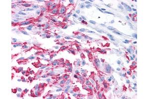 Anti-GRM2 / MGLUR2 antibody IHC of human Skin, Melanoma. (GRM2 抗体  (N-Term))