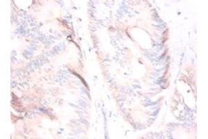 Immunohistochemistry of paraffin-embedded human colorectal carcinoma using MSTN / GDF8 / Myostatin antibody at dilution of 1:50. (MSTN 抗体  (AA 267-375) (HRP))