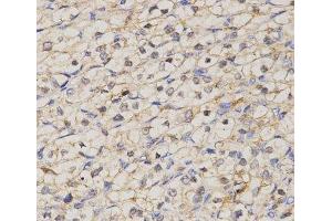 Immunohistochemistry of paraffin-embedded Human kidney cancer using GJC2 Polyclonal Antibody at dilution of 1:200 (40x lens). (GJC2 抗体)