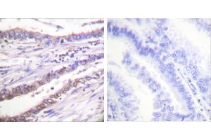 Peptide - +Immunohistochemical analysis of paraffin-embedded human lung carcinoma tissue using Cyclin A antibody (#C0165).
