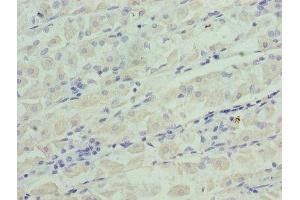 Immunohistochemistry of paraffin-embedded human gastric cancer using ABIN7156368 at dilution of 1:100 (IGFBPI 抗体  (AA 26-259))