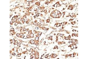 Immunohistochemistry of paraffin-embedded Human mammary cancer using KIR3DS1 Polyclonal Antibody at dilution of 1:100 (40x lens). (KIR3DS1 抗体)