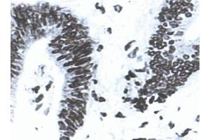Acetone-fixed, frozen tissue section of human colon carcinoma stained for MLH1 (clone G168-15) using a DAB chromogen and Hematoxylin counterstain. (MLH1 抗体)