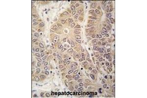 Formalin-fixed and paraffin-embedded human hepatocarcinoma tissue reacted with HARS antibody (N-term) (ABIN391819 and ABIN2841666) , which was peroxidase-conjugated to the secondary antibody, followed by DAB staining. (HARS1/Jo-1 抗体  (N-Term))