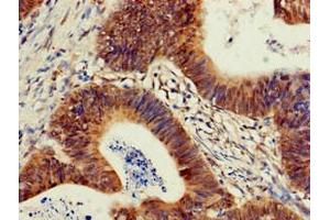 Immunohistochemistry of paraffin-embedded human colon cancer using ABIN7163167 at dilution of 1:100 (PIK3R2 抗体  (Regulatory Subunit beta))