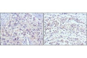 Immunohistochemical analysis of paraffin-embedded human lung cancer (left) and gastric cancer (right) using PAK2 antibody with DAB staining. (PAK2 抗体)