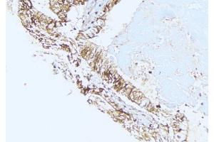 ABIN6275439 at 1/100 staining Human lung cancer tissue by IHC-P. (RSAD1 抗体  (Internal Region))