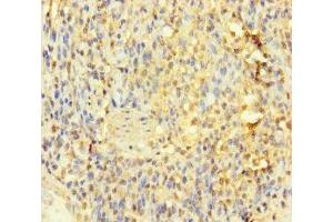 Immunohistochemistry of paraffin-embedded human gastric cancer using ABIN7156759 at dilution of 1:100 (IL1RL2 抗体  (AA 20-218))