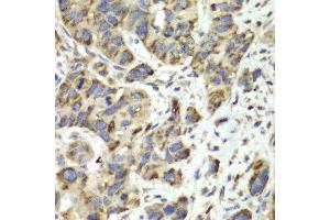 Immunohistochemistry of paraffin-embedded human esophageal cancer using SLC25A4 antibody at dilution of 1:100 (400x lens). (SLC25A4 抗体)