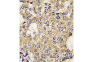 Formalin-fixed and paraffin-embedded human breast carcinoma tissue reacted with Parg antibody , which was peroxidase-conjugated to the secondary antibody, followed by DAB staining. (PARG 抗体  (C-Term))