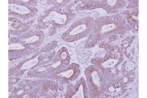 IHC-P Image Immunohistochemical analysis of paraffin-embedded human colon carcinoma, using PKA 2 beta, antibody at 1:500 dilution. (PKA 2 beta (Center) 抗体)