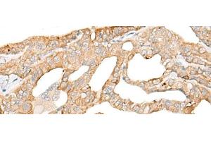 Immunohistochemistry of paraffin-embedded Human thyroid cancer tissue using DDX24 Polyclonal Antibody at dilution of 1:35(x200) (DDX24 抗体)