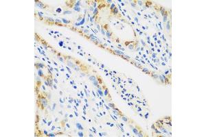 Immunohistochemistry of paraffin-embedded human stomach cancer using CTSG antibody (ABIN5974986) at dilution of 1/100 (40x lens). (Cathepsin G 抗体)