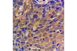 Immunohistochemical analysis of Beta-catenin staining in human breast cancer formalin fixed paraffin embedded tissue section. (beta Catenin 抗体  (N-Term))