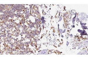 ABIN6276656 at 1/100 staining Human Melanoma tissue by IHC-P. (Ghrelin 抗体  (C-Term))