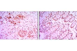 Immunohistochemical analysis of paraffin-embedded colon cancer tissues (left) and human larynx cancer tissues (right) using KDM4A mouse mAb with DAB staining. (KDM4A 抗体)