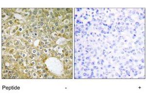 Immunohistochemistry analysis of paraffin-embedded human breast carcinoma tissue using ACVRL1 polyclonal antibody . (ACVRL1 抗体)