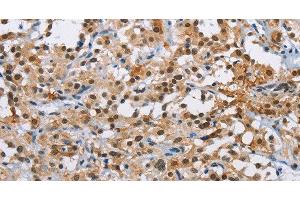 Immunohistochemistry of paraffin-embedded Human thyroid cancer using ATXN1 Polyclonal Antibody at dilution of 1:40 (Ataxin 1 抗体)